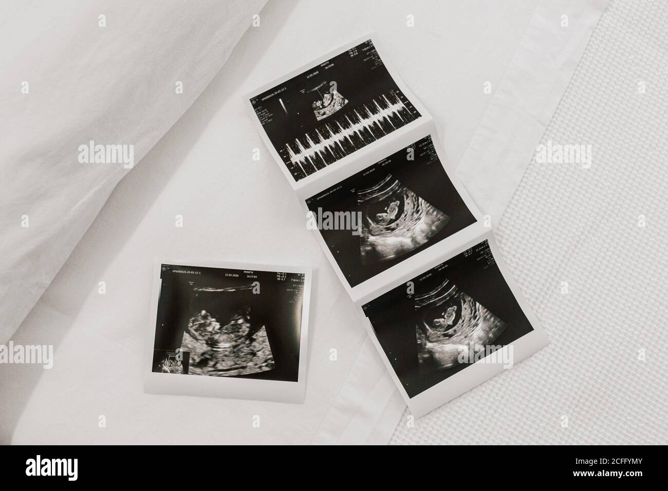 Top view of ultrasound scans of unborn baby placed bed in ward of fertility clinic Stock Photo