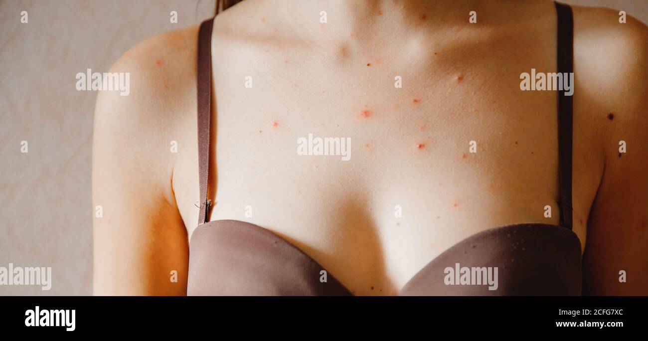 Close-up skin of adult woman affected by chickenpox, acne and dermatology Stock Photo