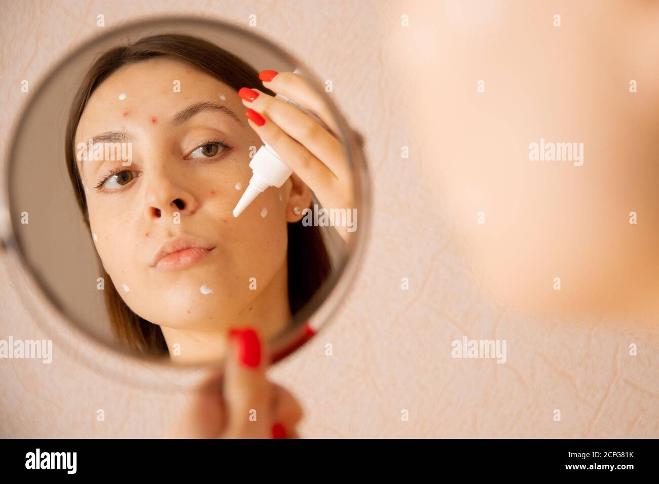 Young caucasian woman is applying cream against acne and chicken pox on her face, looking in mirror Stock Photo