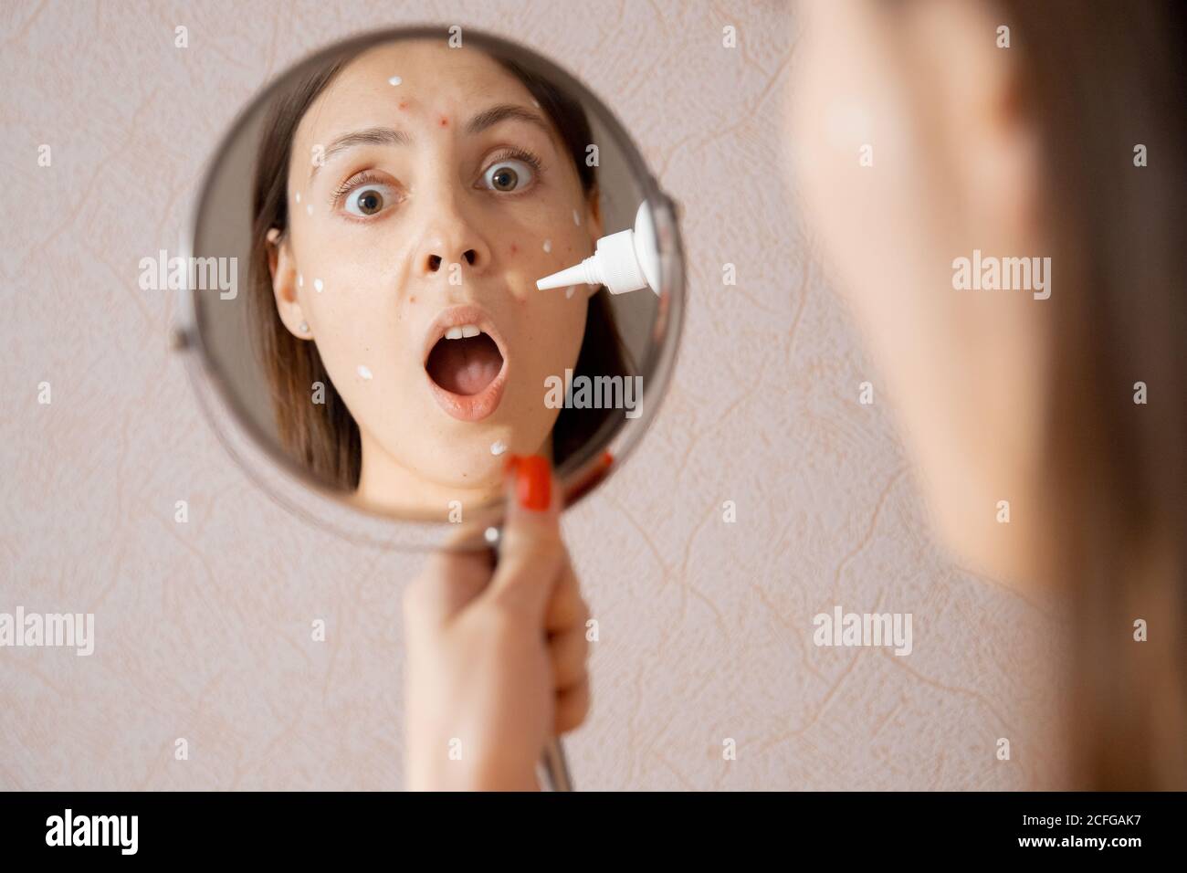 Young caucasian woman is applying cream against acne and chicken pox on her face, looking in mirror Stock Photo