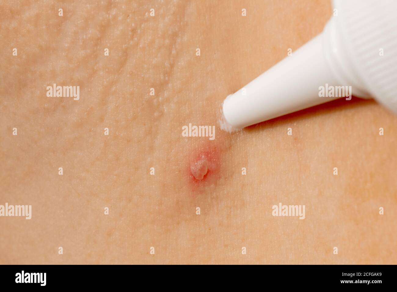Woman applying cream on skin body ill with chickenpox Stock Photo
