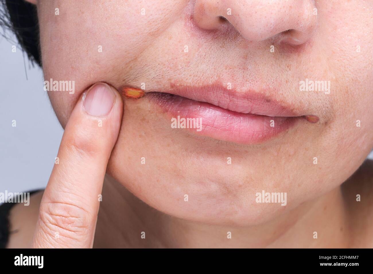 Angular cheilitis is a type of common inflammation of the lips Stock