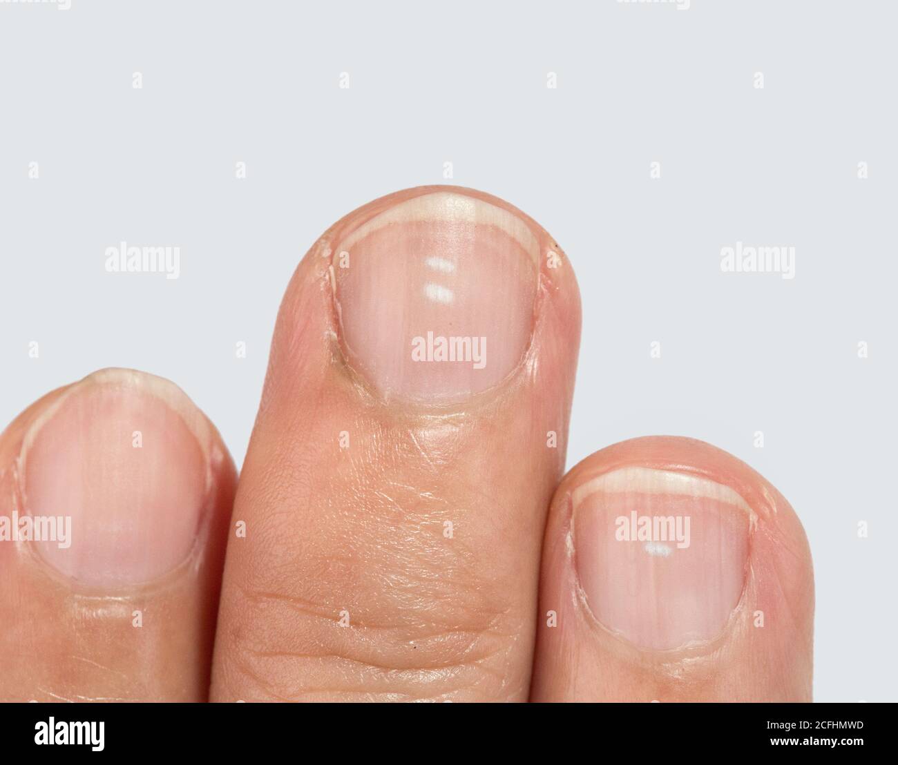 Worried About White Spots On Fingernails? - DrWeil.com