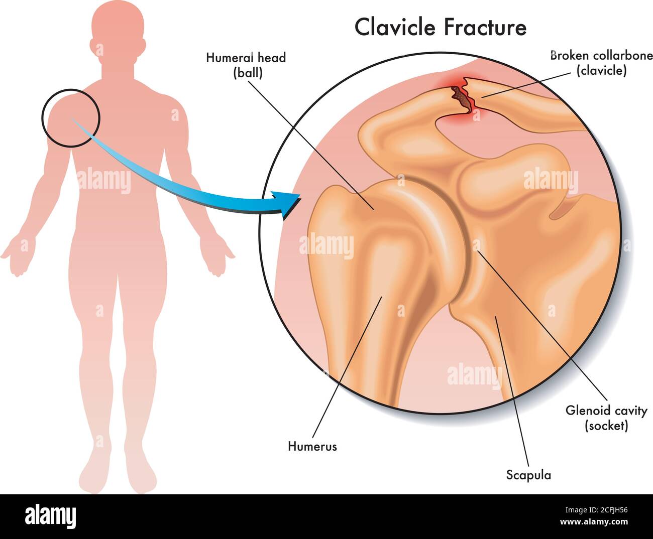 Medical illustration of a clavicle fracture and its location in the human body, with annotations. Stock Vector