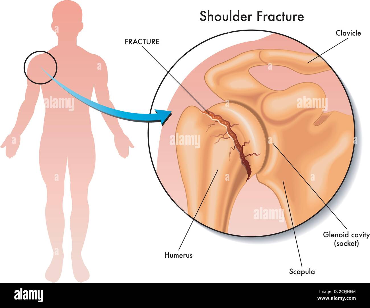 Medical illustration of a shoulder fracture and its location in the human body, with annotations. Stock Vector