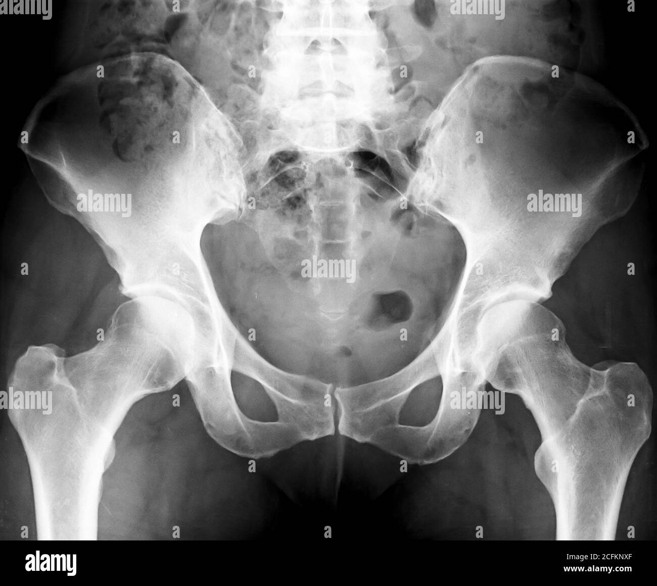 Pelvis X-Ray, human skeleton image Stock Photo - Alamy