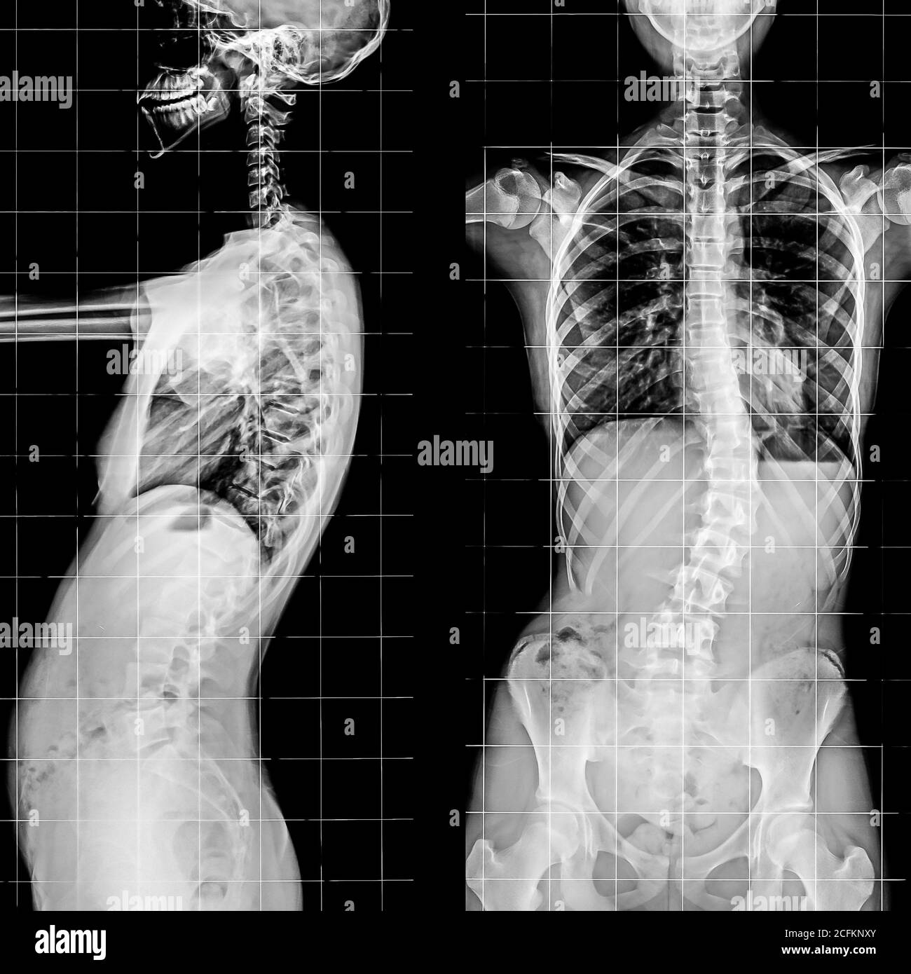 X-ray of the Spinal Column and Pelvis of human skeleton. Stock Photo