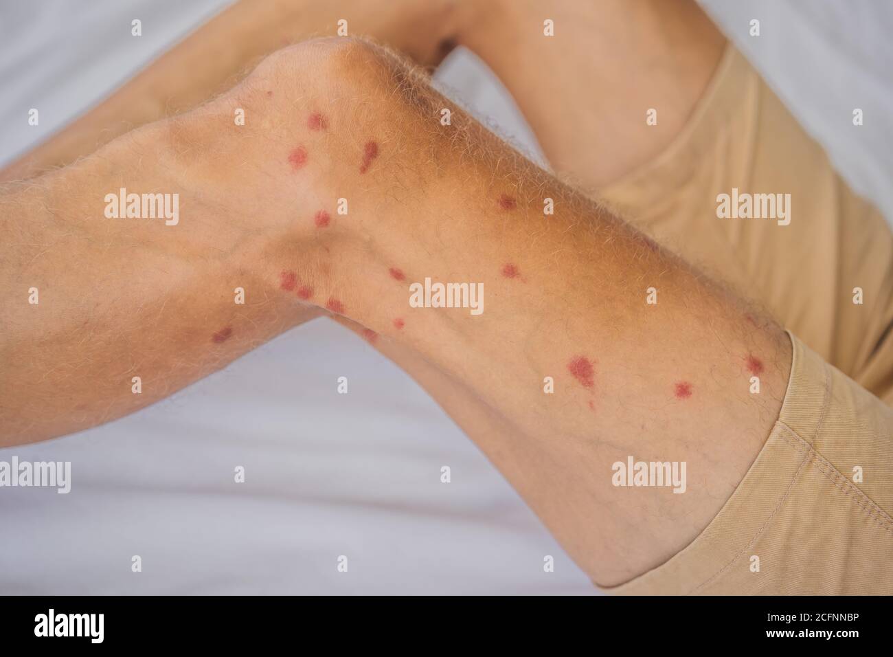 sand-fly-bites-hi-res-stock-photography-and-images-alamy