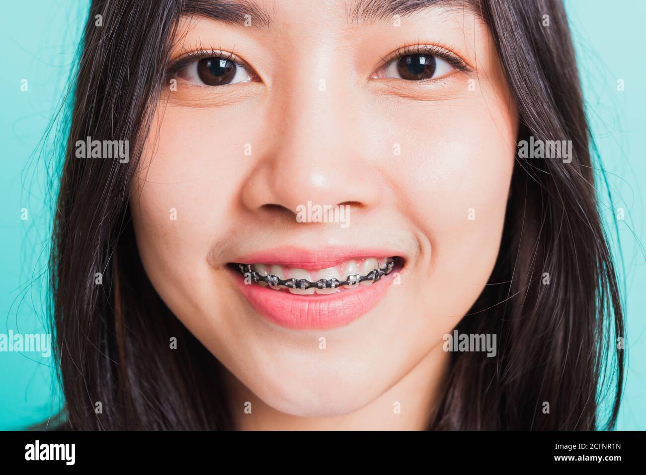 Closeup Teen Asian Beautiful Young Woman Smile Have Dental Braces On