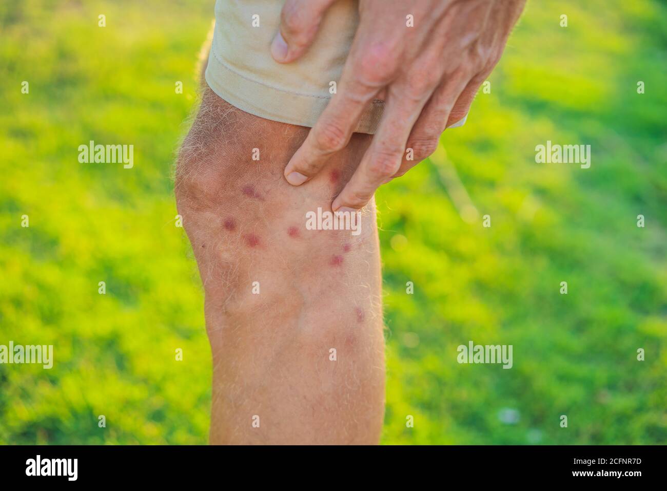 Legs with many red spot and scar from insect bites. Mosquitos allergy