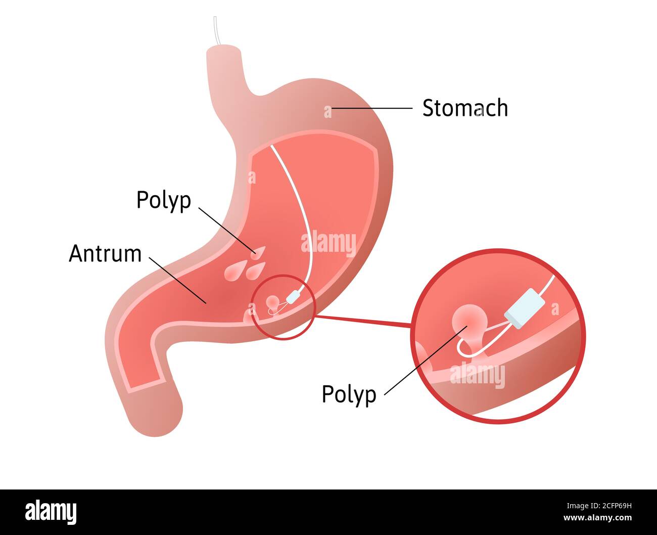Removal of gastric polyps, masses of cells inside stomach. pedunculated and flat-based polyp. Antrum. Medical vector illustration marked with lines. Stock Vector
