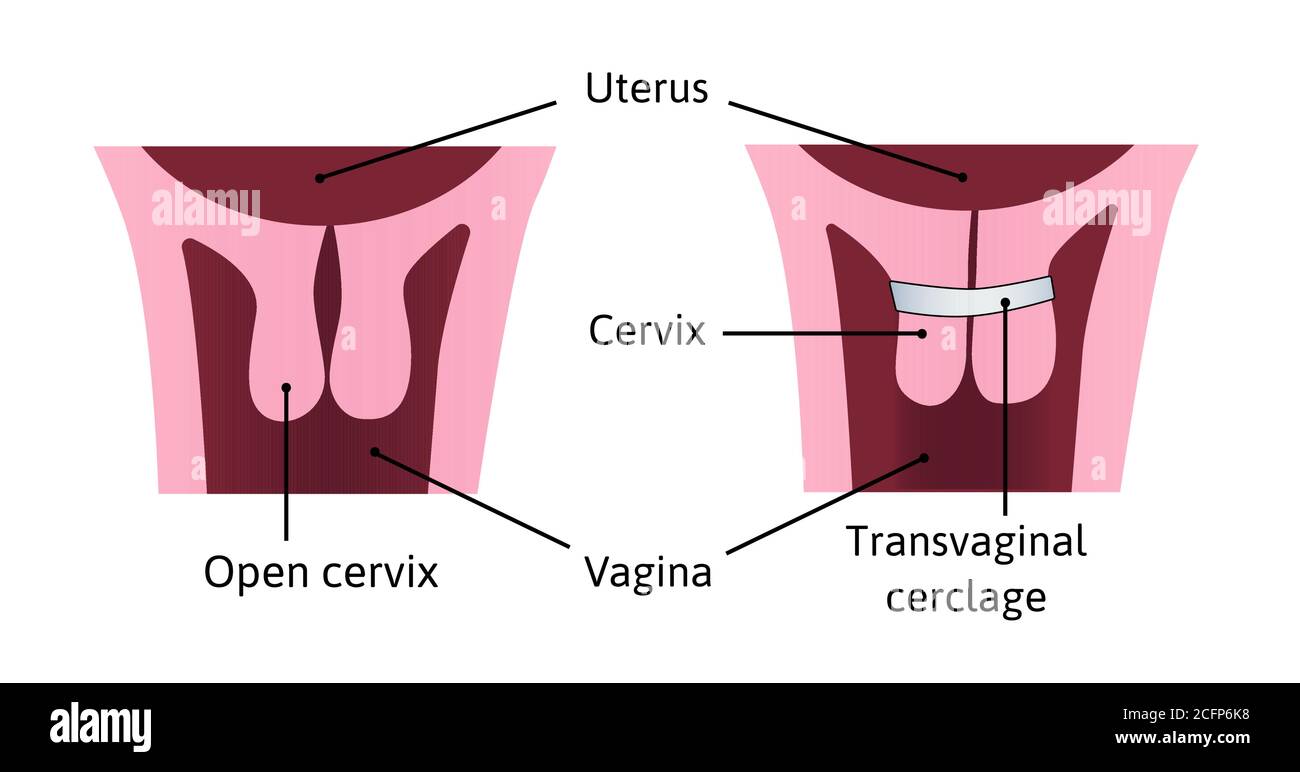 Cervical cerclage tightening of cervical opening during pregnancy. problem, injury. uterus with open cervix and light blue cerclage on it. vector Stock Vector