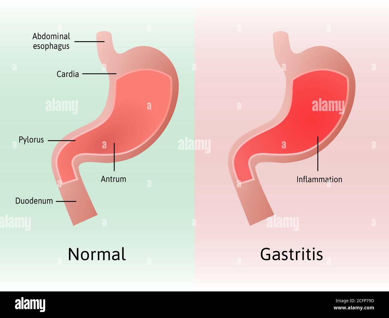 Gastritis, an inflammation, irritation, or erosion of the lining of the stomach. Medical vector illustration marked with lines. All parts of stomach Stock Vector