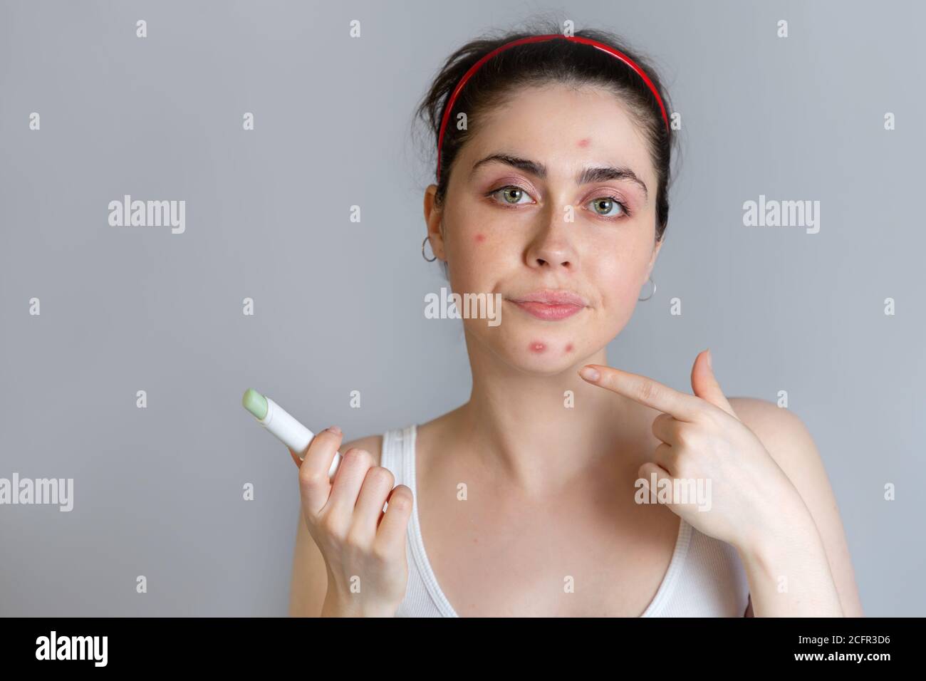 A disgruntled young woman points to acne on her chin. The concept of acne, growing up and cosmetology. Copy space. Stock Photo
