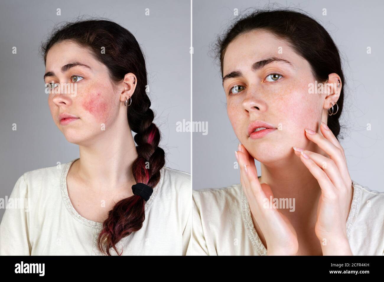 Portrait of a young Caucasian woman showing redness and inflamed blood vessels on her cheeks. Gray background. The concept of rosacea and couperose. B Stock Photo