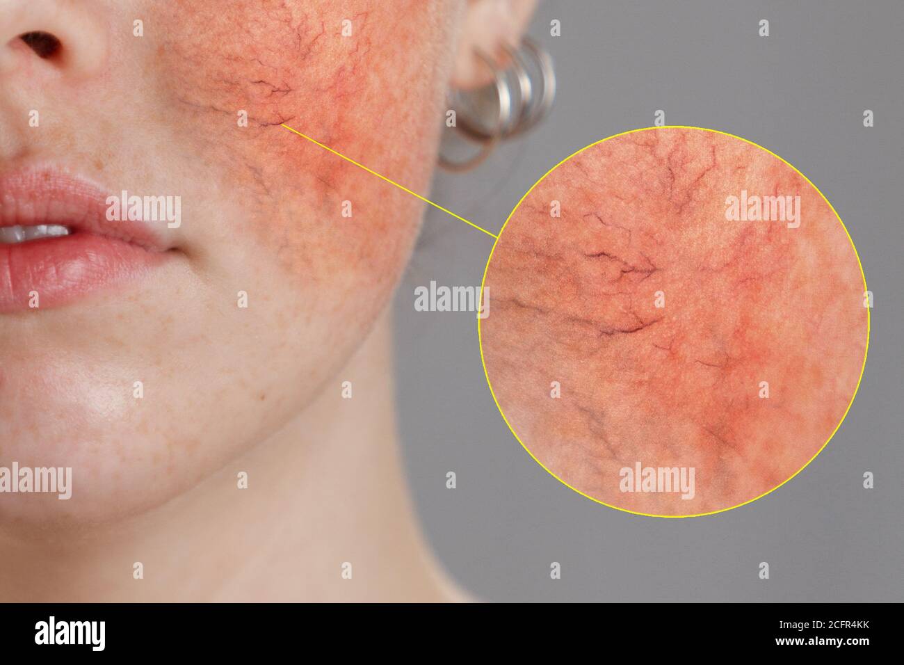 Cosmetology and rosacea. Close-up portrait of female face, cheeks with severe inflammation, blood vessels and rosacea. Stock Photo