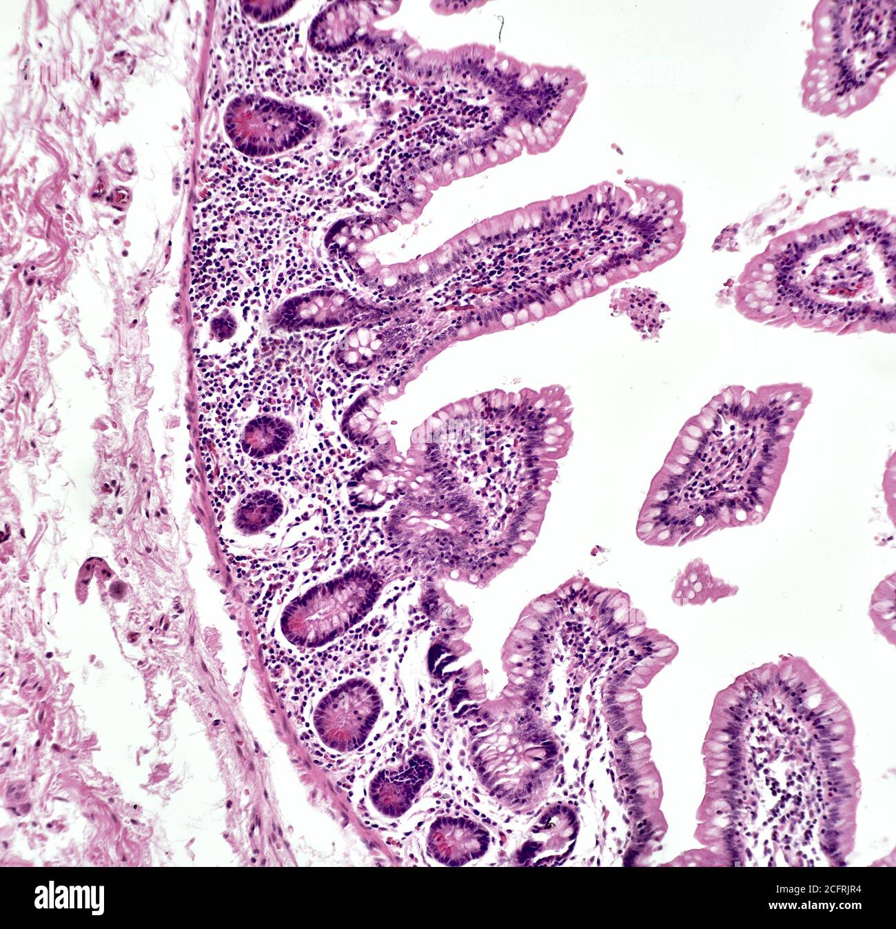 Intestinal cancer cells, brightfield photomicrograph Stock Photo