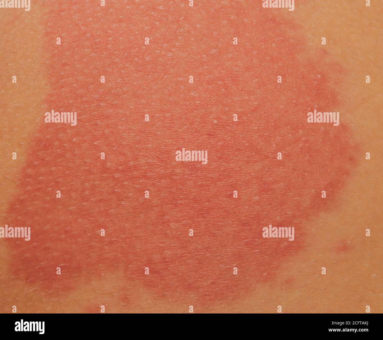 Skin Burn Shoulder High Resolution Stock Photography and Images Alamy