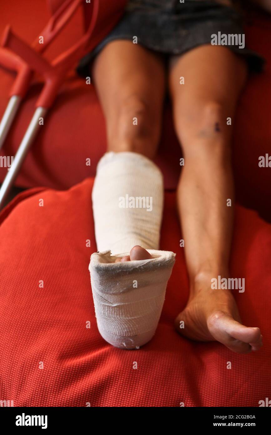 woman with one leg in plaster Stock Photo