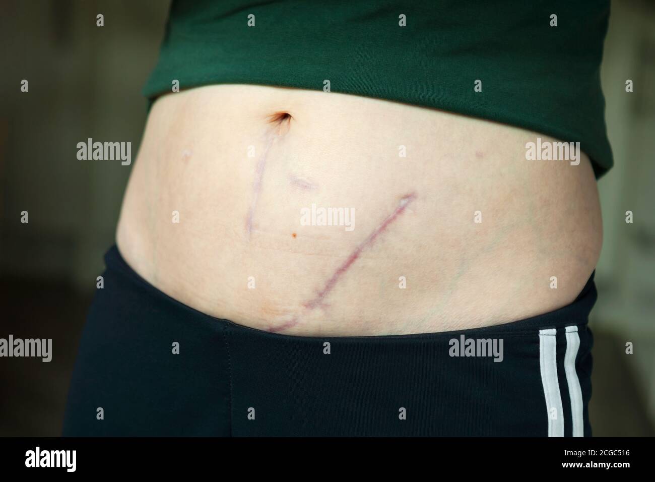 Scars from a kidney transplant and peritoneal dialysis exit site scars, on a female's stomach Stock Photo