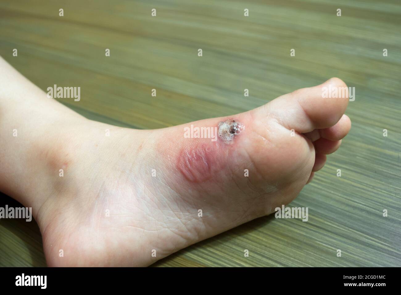Foot Burn Injury High Resolution Stock Photography And Images Alamy