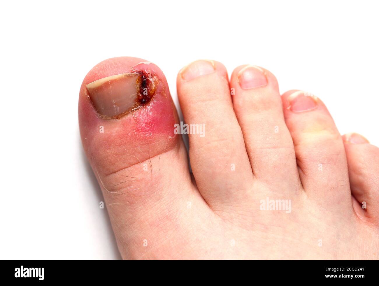 Infected ingrown toenail on a teenage male’s big toe against a white background. Stock Photo