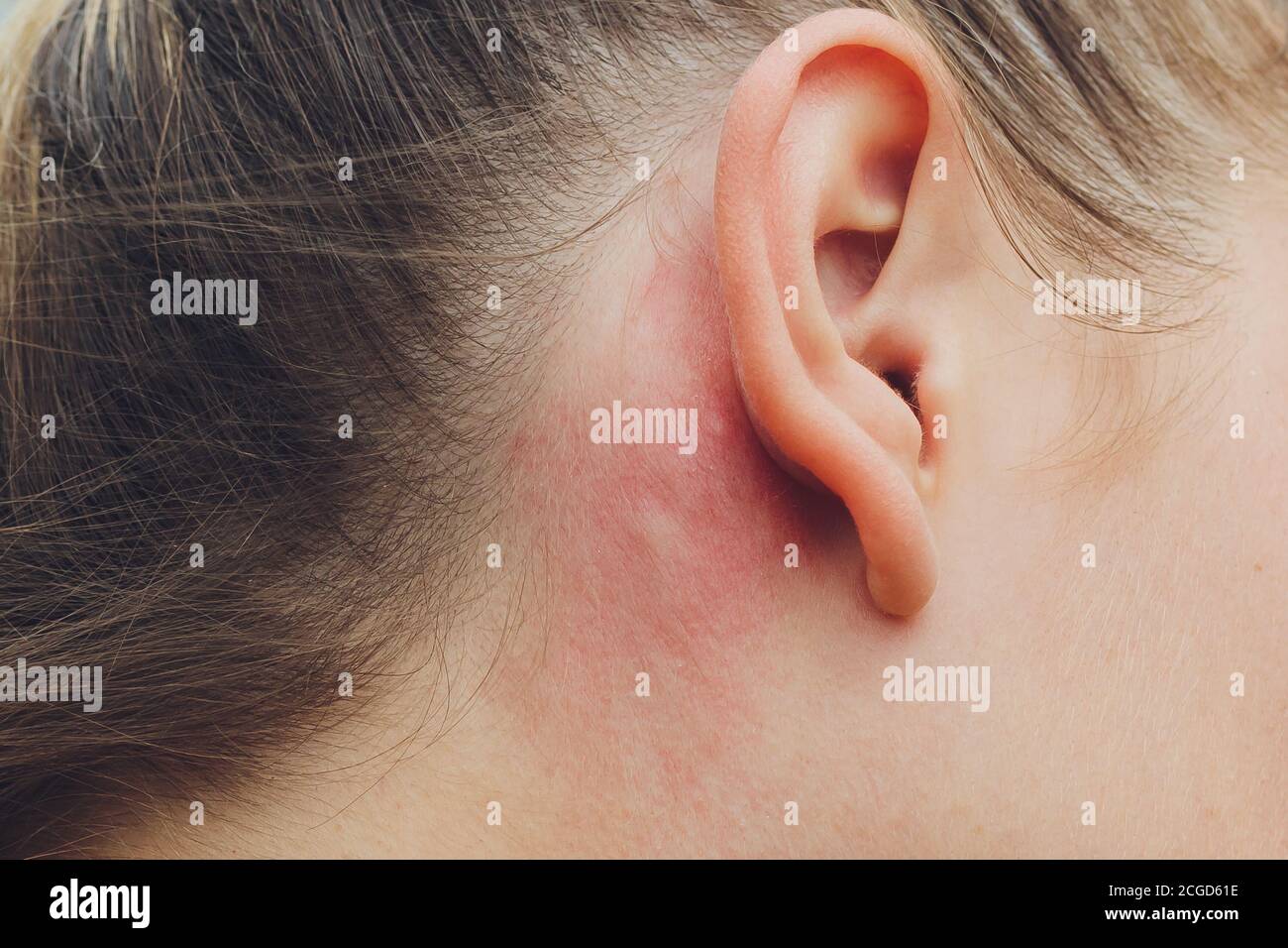 Allergic skin reaction on the man behind the ear caused by insects