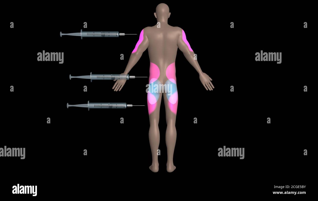 Injection sites on body.Common areas on body to inject drugs , vaccines ...