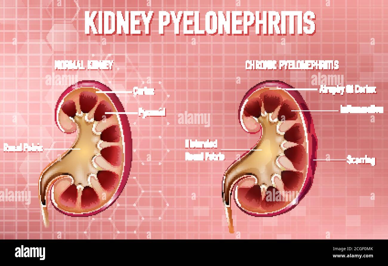 Informative illustration of Pyelonephritis illustration Stock Vector