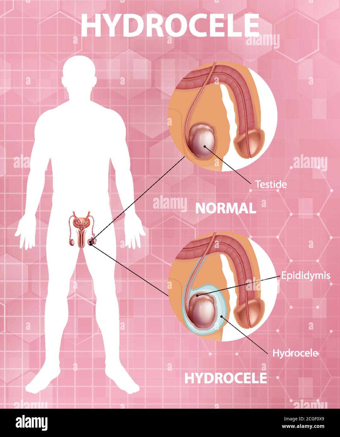 Medical poster showing different between male normal testicle and hydrocele illustration Stock Vector