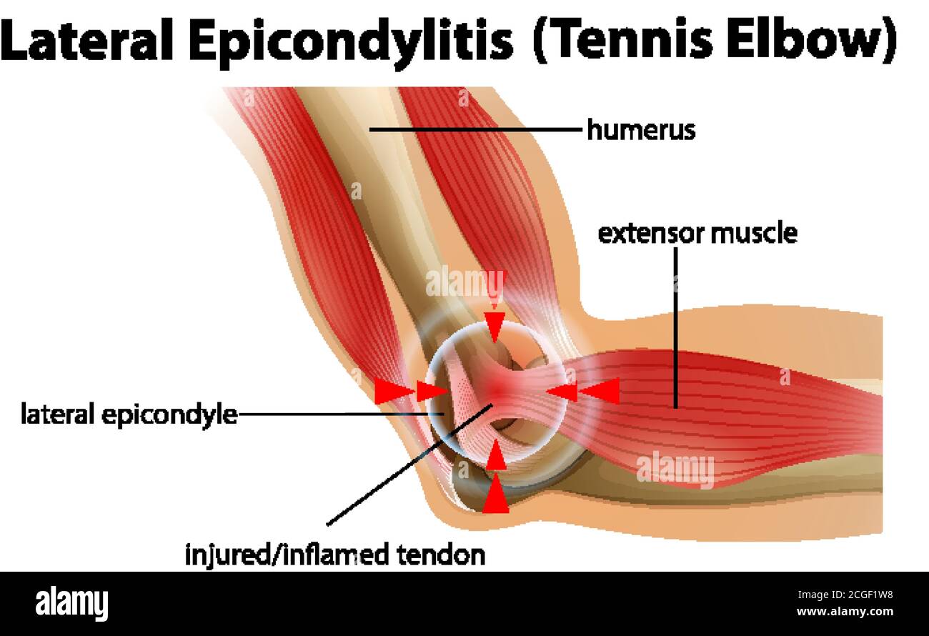 Lateral Epicondylitis or tennis elbow Stock Vector Image & Art - Alamy
