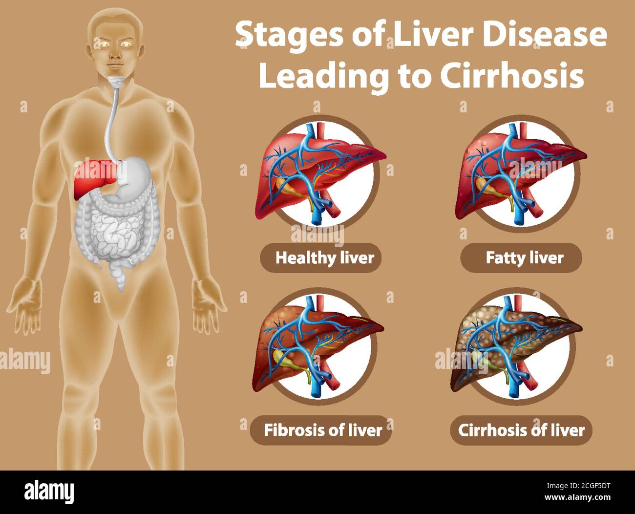 Stages of liver disease leading to Cirrhosis illustration Stock Vector ...