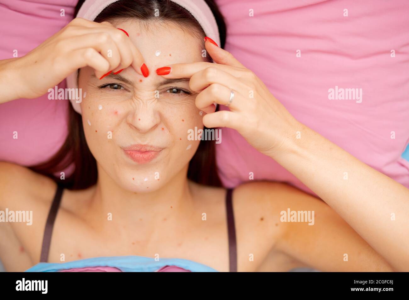 Itching and burning acne chickenpox on face of young beautiful woman