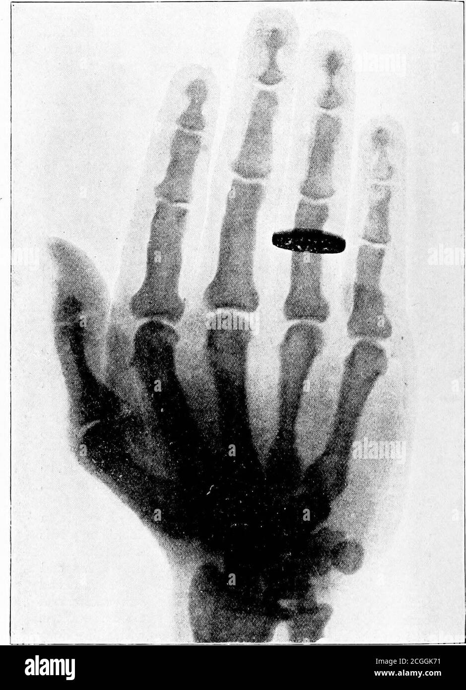 . Acromegaly . lready described in thechapter on the pathological anatomy (p. 27 and Fig. 8).Sometimes the sternum is as strongly arched forwards as inaneurism of the aorta (Moritz). In many cases the kyphosis is said to have originated aftera trauma (Farge, Brissaud, and Meige). It is important tonotice that the kyphosis and the deformity of the chest may,in certain circumstances, and also in pronounced cases, beabsent (vSchultze, Du Cazal, Dercum, Kalindero, Lichtheim,Roxburgh and CoUis, Sears, Regnault). The great increase in size of the hands chiefly depends onthe soft parts. This fact was Stock Photo