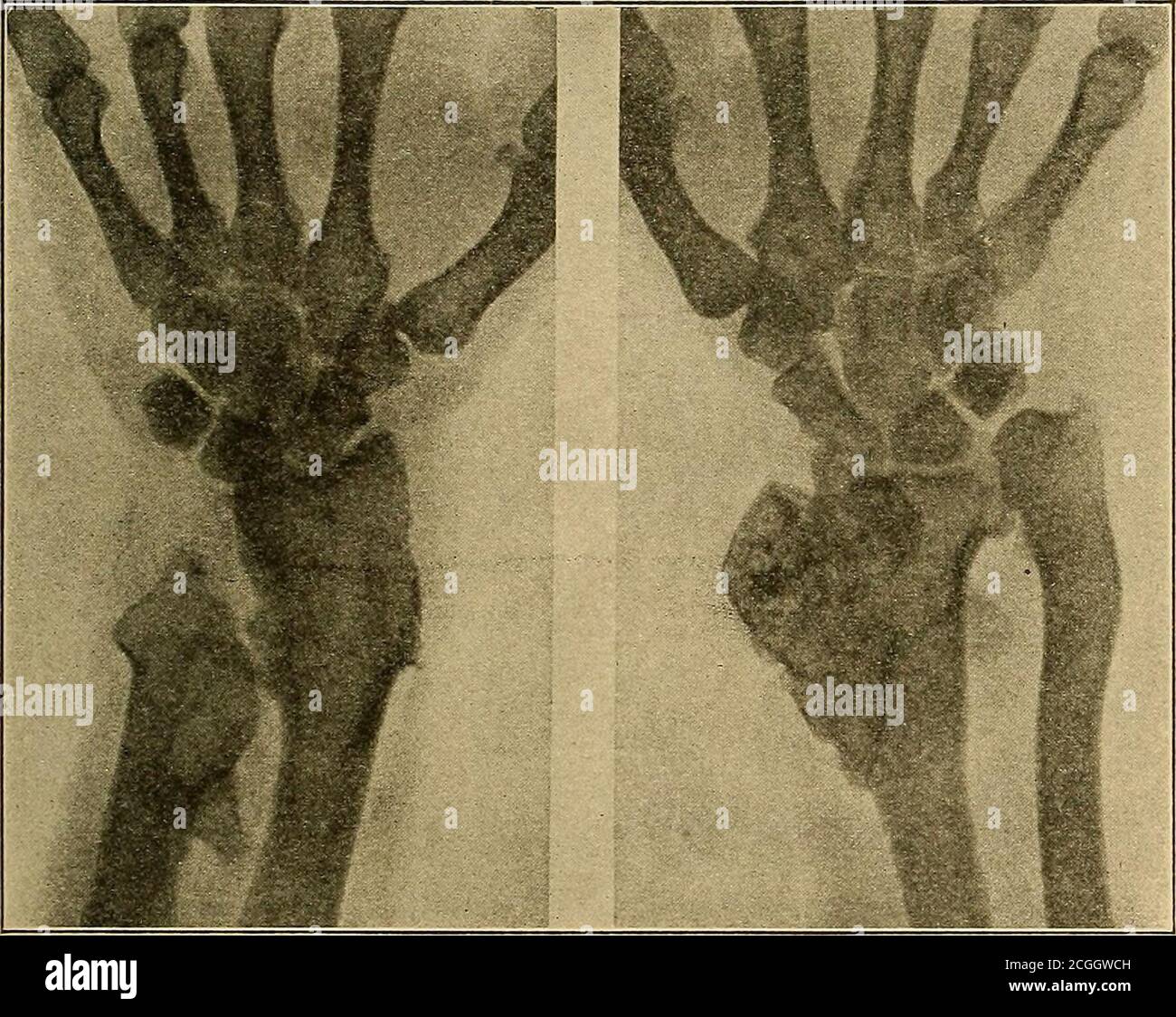 . Physical diagnosis . Fig. 25.—Radiographs of the Hand and Arm ofa ...