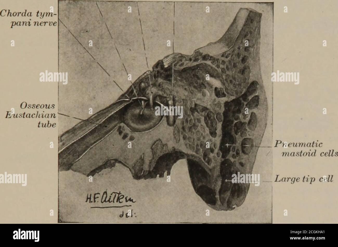 Hammer, Anvil & Stirrup by otoscopy. Bones of the middle ear