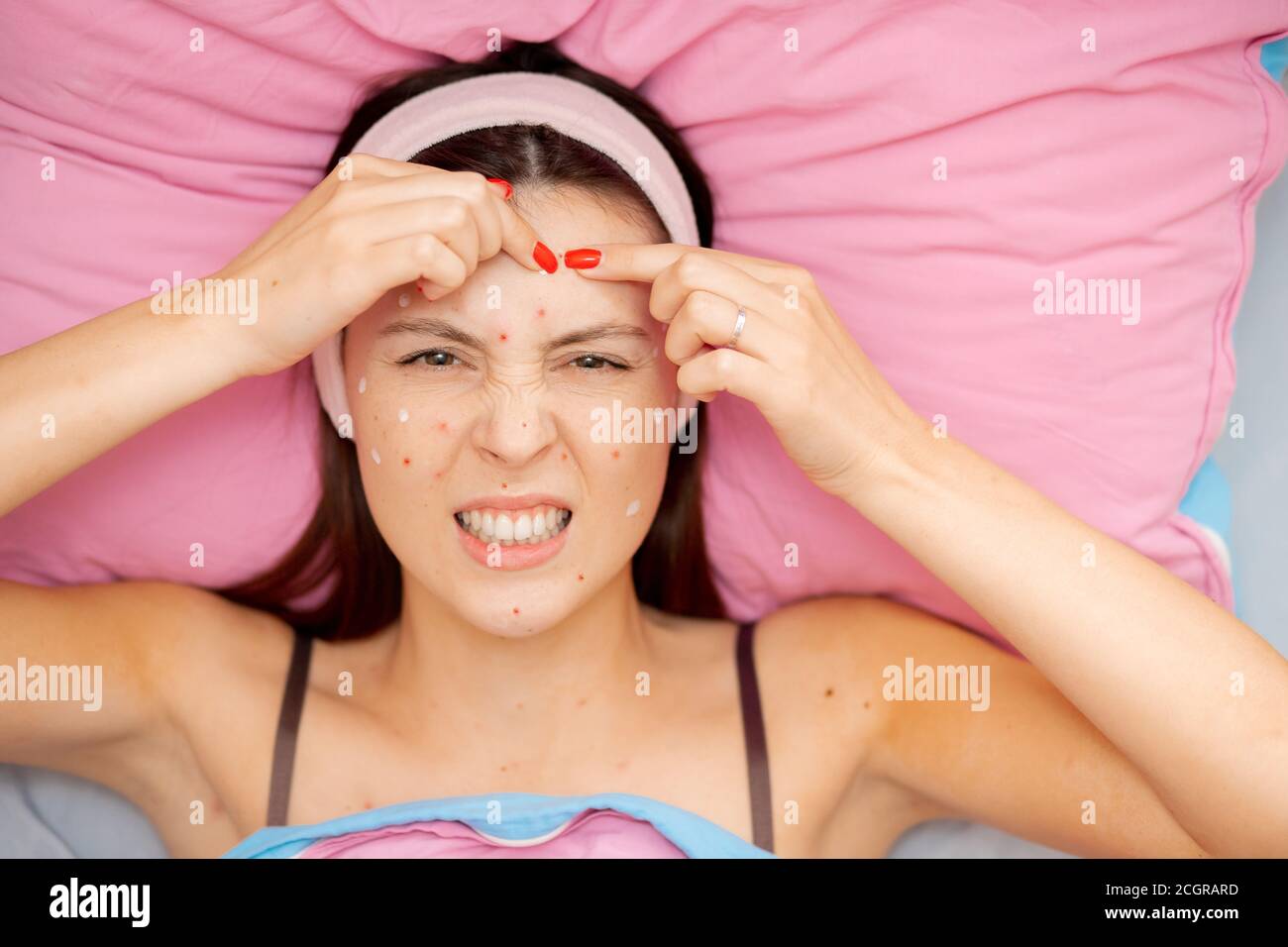 Skin of face of young woman is affected by chickenpox, acne defects Stock Photo