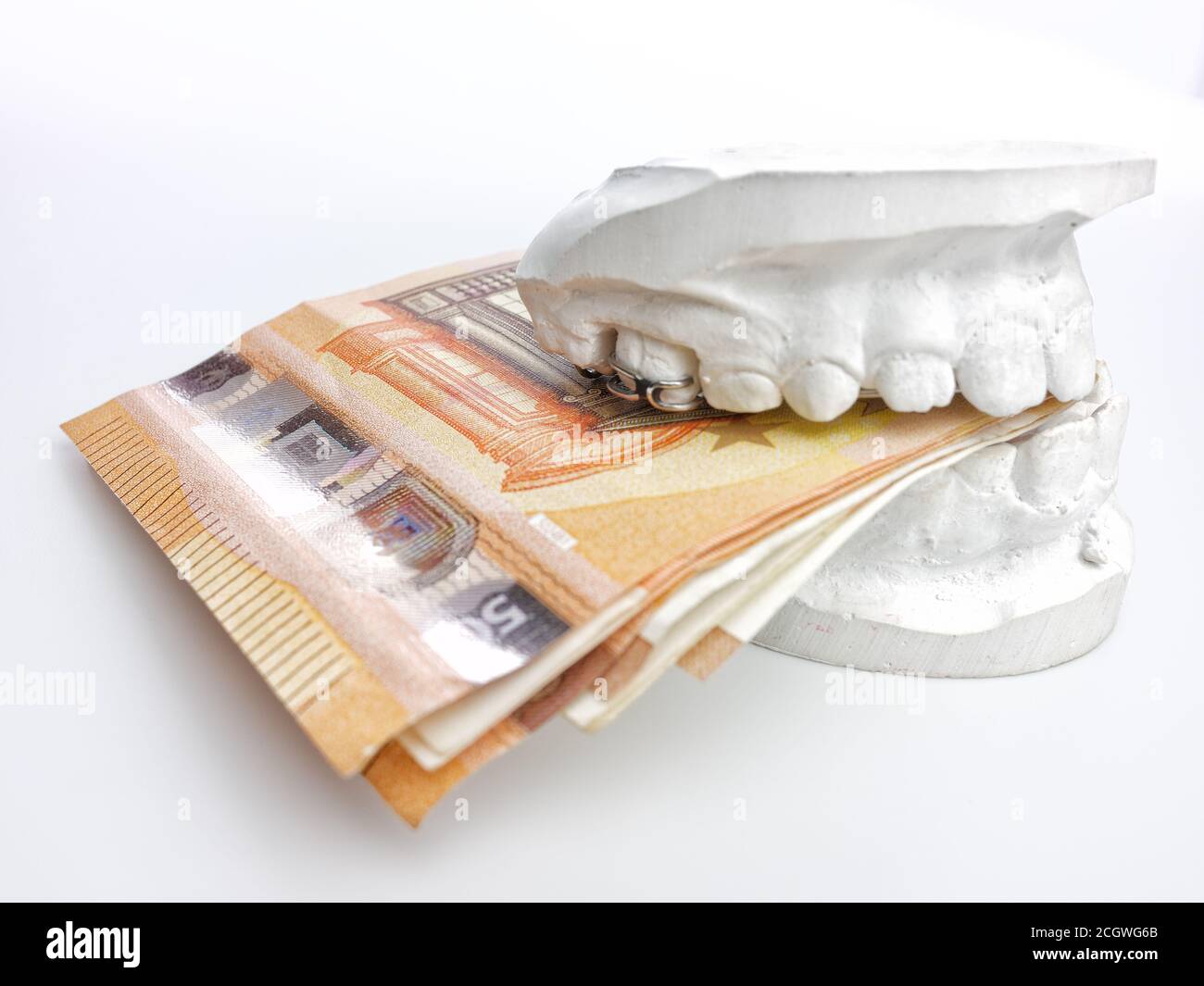 Closeup kid orthodontic dental impression chalk model biting euro money