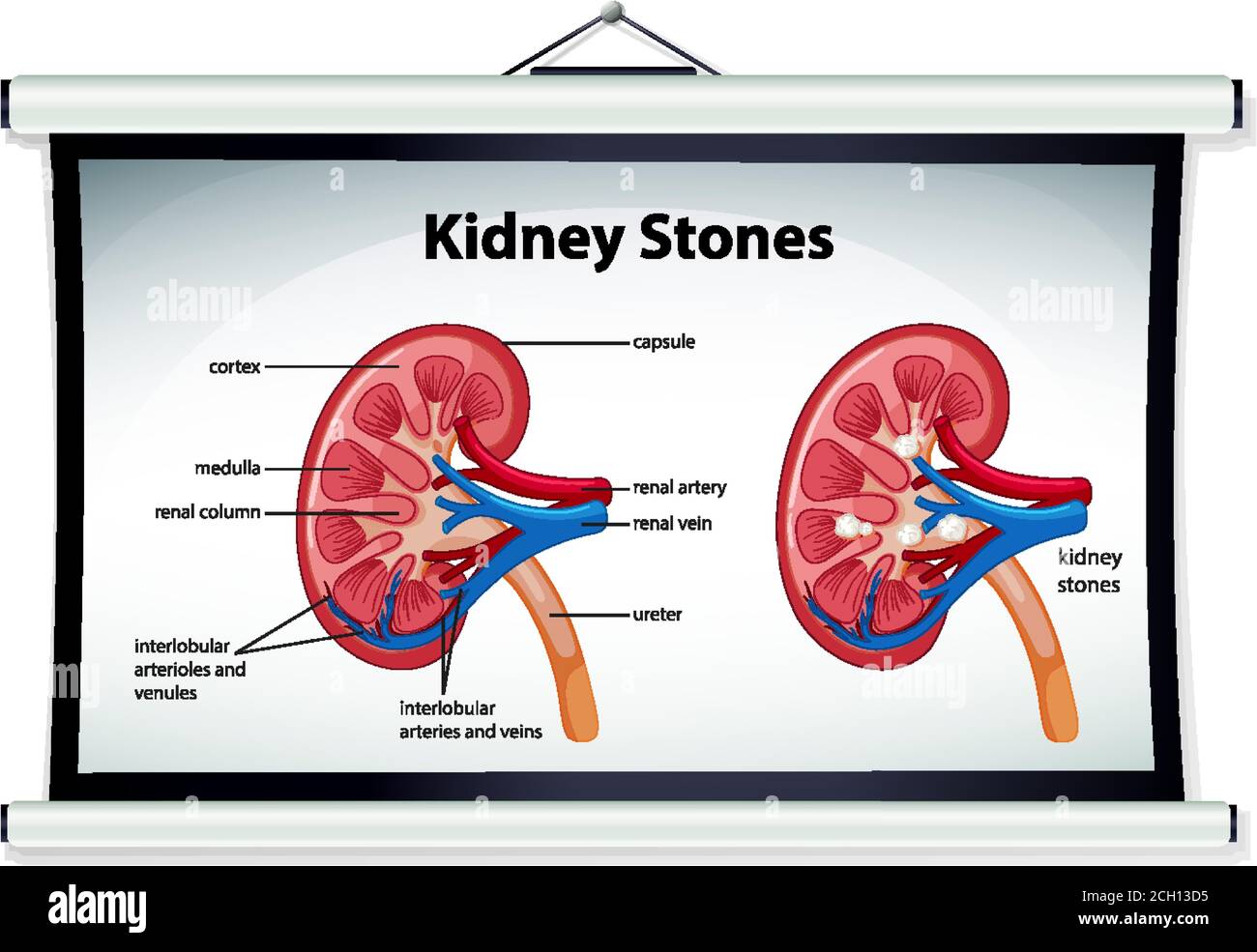 Kidney Stones Symptoms Cartoon Style Infographic Illustration Stock Vector Image Art Alamy