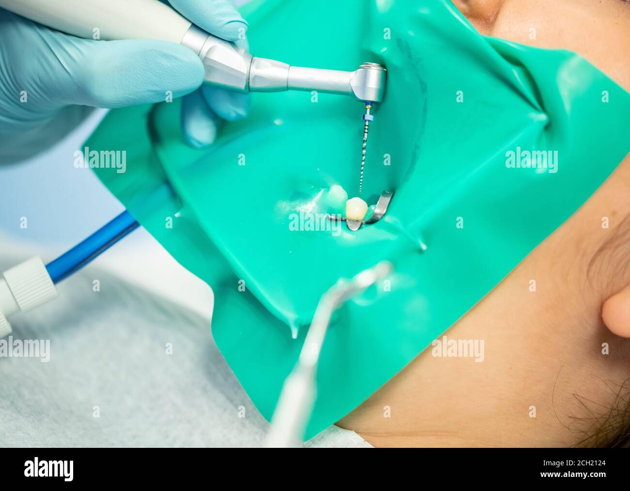 Treatment of dental canals in the bottom molar permanent molar using an apex locator file, a tooth with a clip attached to it with a cofferdam. Stock Photo