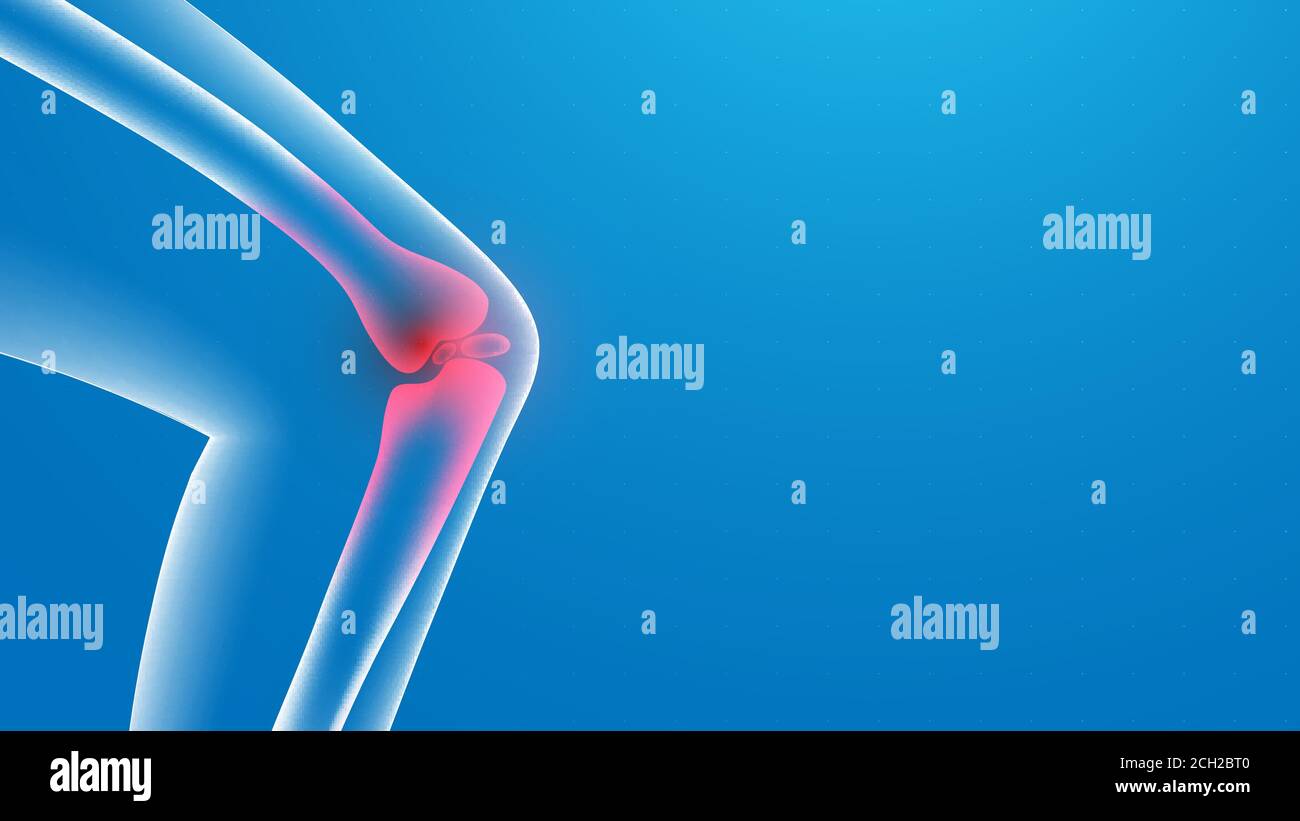 Knee painful. x-ray. Joint pains. 3d Vector illustration Stock Vector ...