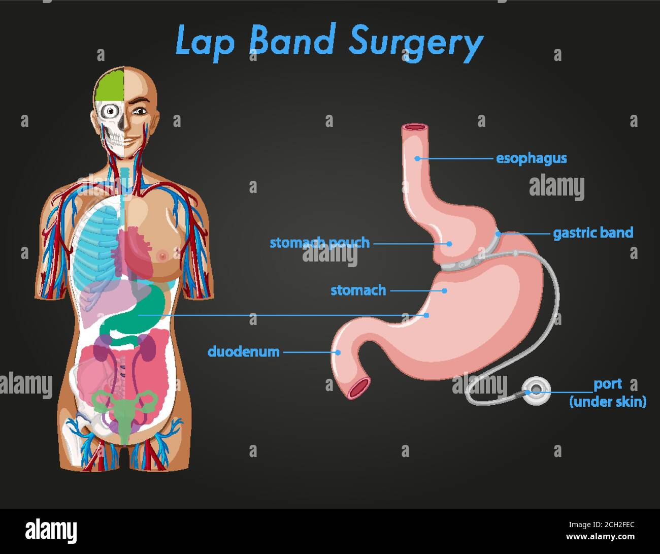 Lap band surgery anatomy illustration Stock Vector Image & Art Alamy