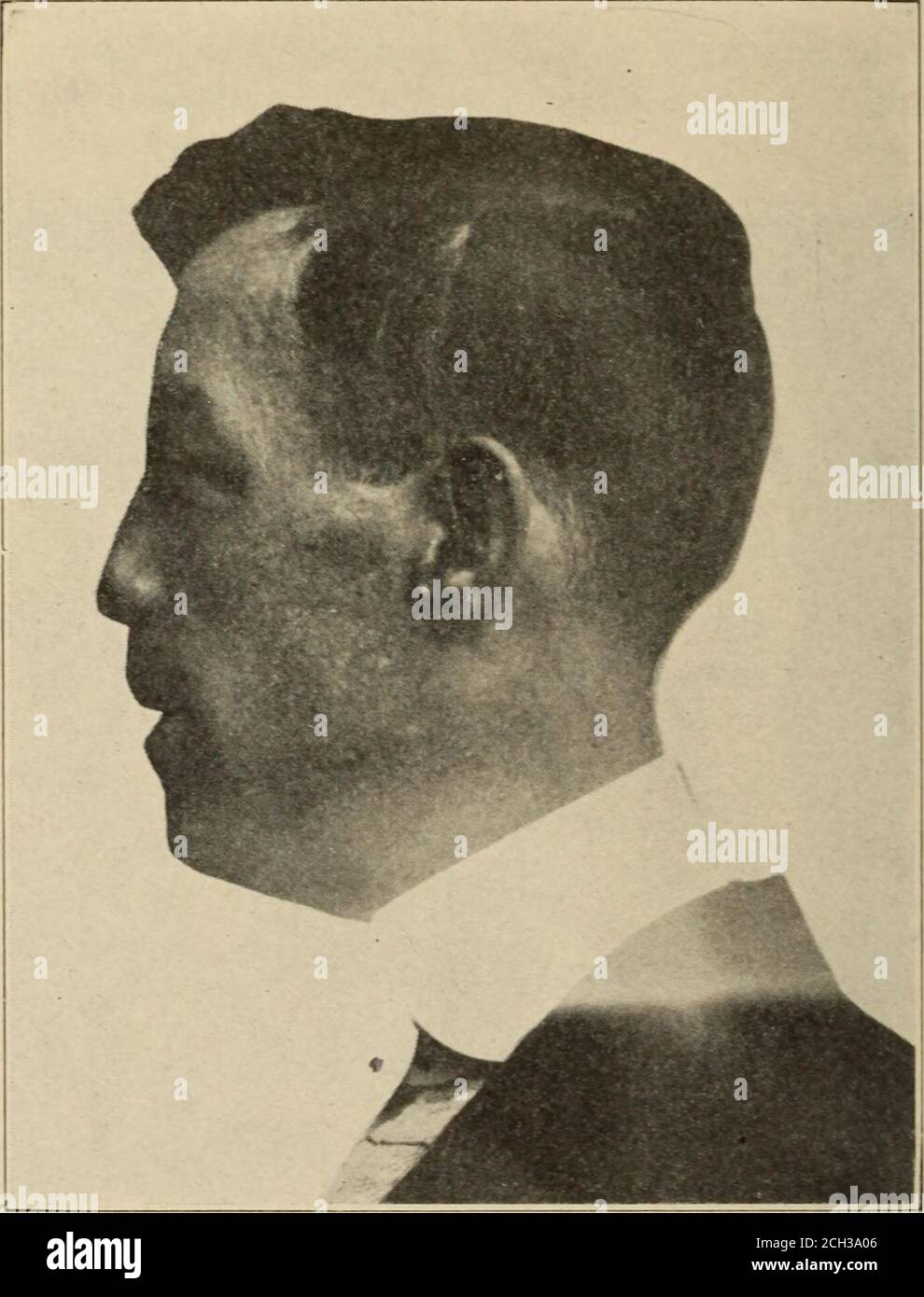 . The Hahnemannian monthly . Fig. 1.—Before Operation. ity, I had an opportunity to try the operation upon an appro-priate case, with very good results. The patient, a man thirty-two years of age, was infected with lues eleven years ago. Theseptum of the nose was affected and destroved and a marked 266 The Hahncmannuin Monthly [April, depression of the nasal bones followed. There were no activesigns of the disease at the time of operation and no breakin the mucus membrane of the nose. A wax model of thesize and shape of the defect was made, an oblique incision wasthen made over the seventh cos Stock Photo
