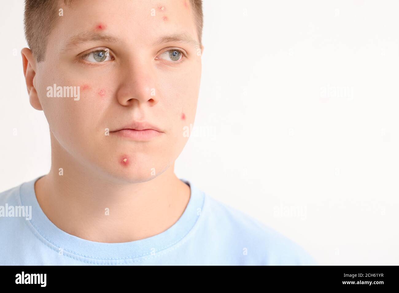 Teenage boy with acne on light background Stock Photo - Alamy