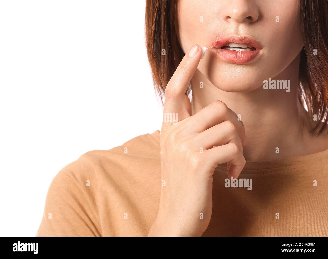 young-woman-with-cold-sore-applying-ointment-on-her-lips-against-white