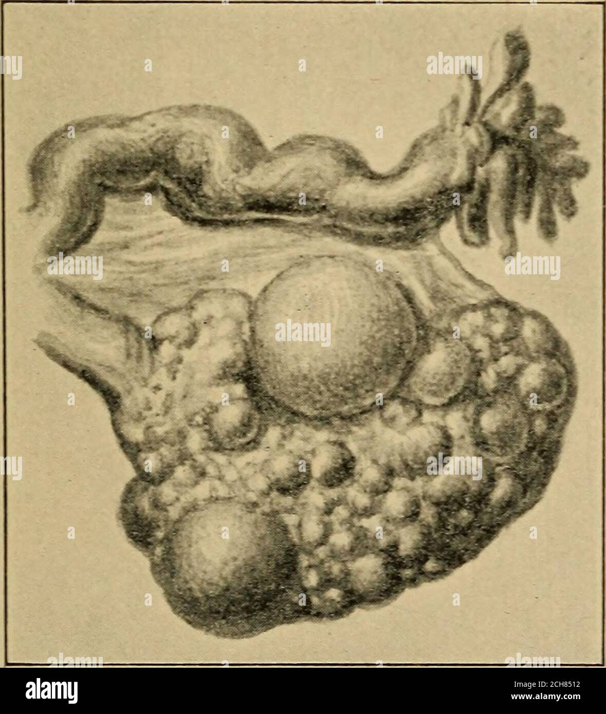 . Atlas and epitome of gynecology . Fig. 34.—Senile cirrhotic atrophy of the ovary.. Fig. 35.—Oligocystic degeneration of the ovary. inflammations of the tubes. (Fig. 36.) This oophoro-salpingitis is combined with perimetrosalpingitis, peri-metro-oophoritis, and pyosalpinx, forming, together withencapsulated ovarian and peritoneal pus sacs, a large ag- 128 CHRONIC OOPHORITIS. PLATE 44. Pelvic Peritonitis, Perioophoritis, Perisalpingitis and Right=sided Pyosalpinx. View of the pouch of Douglas. Pseudoliga-inents fix the uterus aud its aduexa to the sigmoid flexure. The lefttube is beut at an an Stock Photo