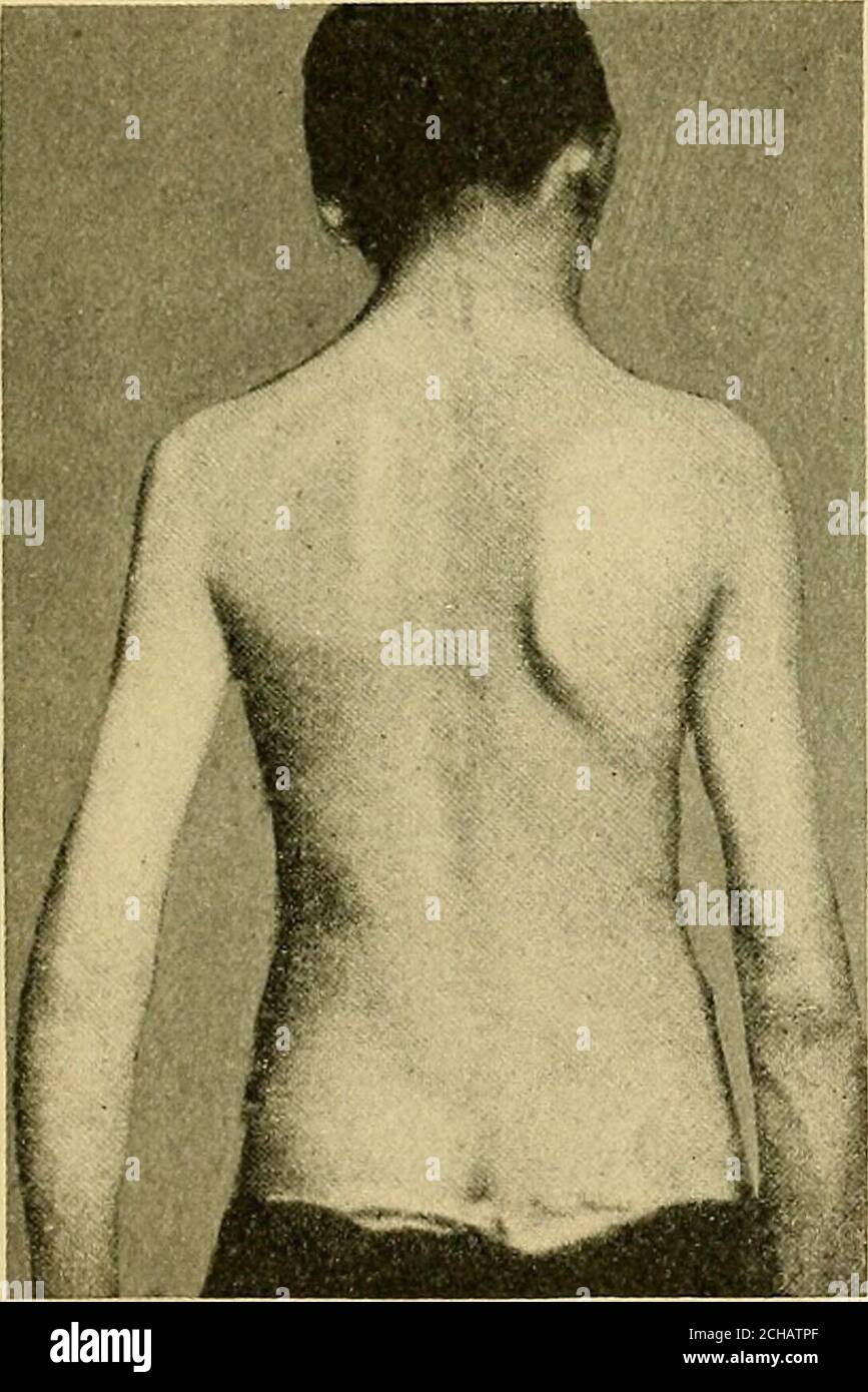 https://c8.alamy.com/comp/2CHATPF/lateral-curvature-of-the-spine-and-round-shoulders-will-sometimesshow-a-slight-tendency-to-curve-to-the-right-in-the-dorsal-region-which-functional-scoliosis-si-may-be-due-to-the-physiological-curve-to-the-right-there-or-to-a-beginningstructural-change-functional-curves-disappear-on-suspension-orrecumbency-and-side-flexibility-is-but-little-limited-bending-to-theleft-being-perhaps-somewhat-restricted-in-cases-of-right-curesthe-description-is-reversed-the-changed-relation-of-the-shoulders-to-the-pelvis-is-more-evidentin-children-with-a-lumbar-curve-than-in-cases-with-round-backs-t-2CHATPF.jpg
