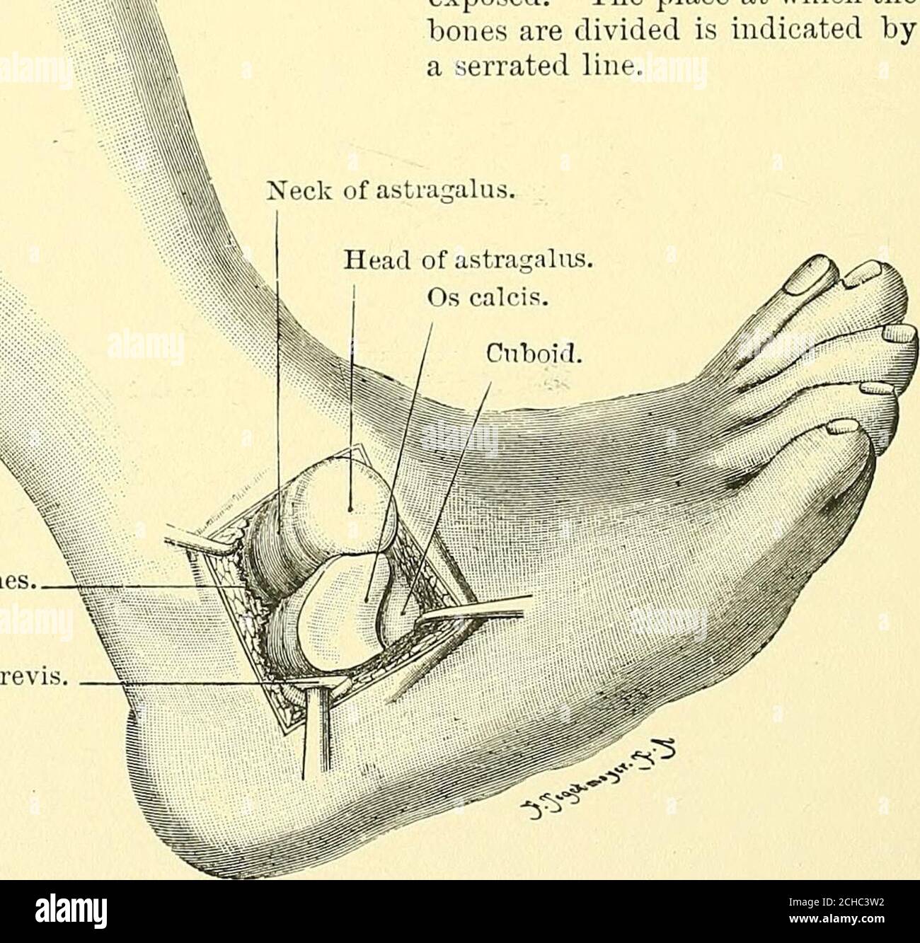 . Textbook of operative surgery . ^ 3 Fig. 144.—Excision of an