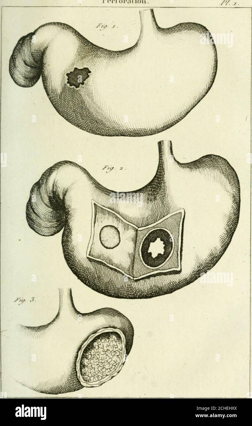 Dictionaire des sciences médicales, . par une affection gangreneuse. 2. Le  même estomac, dont on a enlevé un lambeau carré de la tunique péritonéale  pour faire voir la perfo-ration à lintérieur