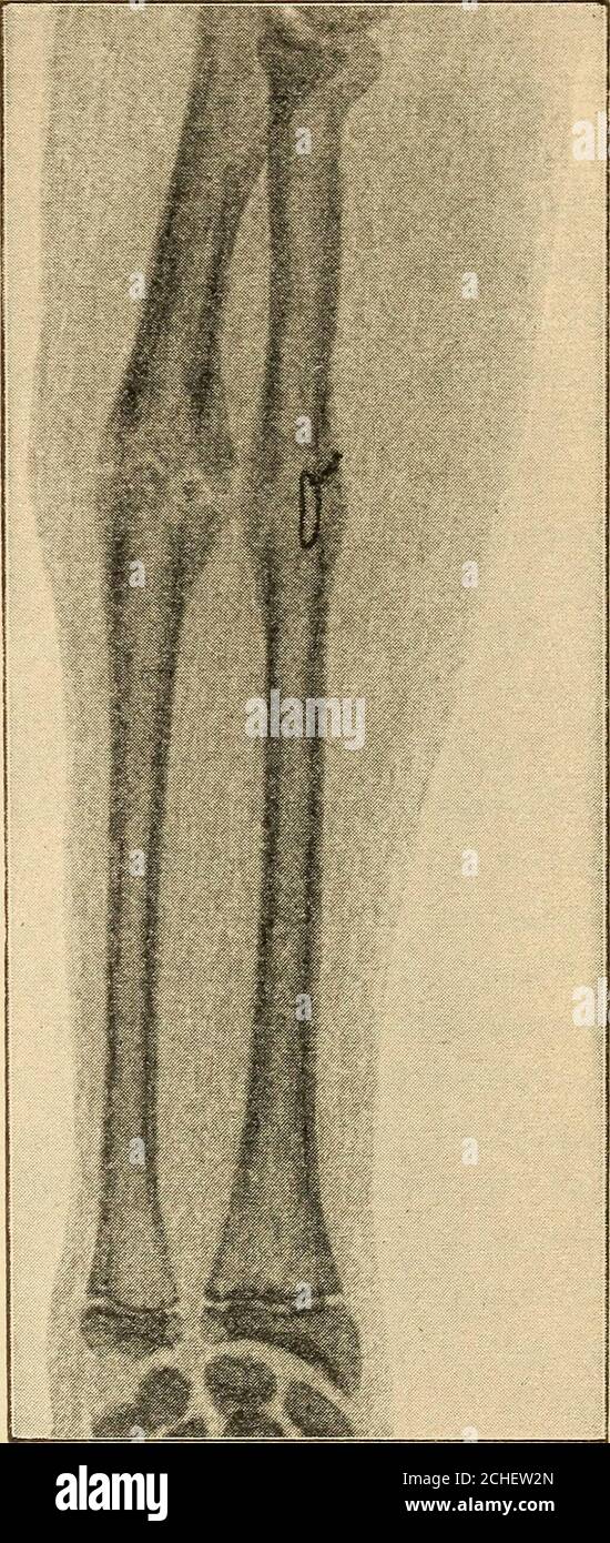 https://c8.alamy.com/comp/2CHEW2N/atlas-and-epitome-of-traumatic-fig-87-a-fig-87-b-figs-87-a-and-87-bfracture-of-the-forearm-with-marked-de-formity-the-fragments-were-reduced-by-operation-and-the-bonesunited-by-suture-skiagraph-the-patient-j-schmidt-seventeenyears-old-fell-from-his-wheel-and-struck-on-the-left-arm-fractureof-the-forearm-with-marked-dislocation-especially-of-the-lower-radialfragment-which-completely-overlies-the-shadow-of-the-seat-of-fracturein-the-ulna-the-latter-presents-only-slight-displacement-of-the-frag-ments-fig-87a-although-the-patient-was-anesthetized-reductionwas-impossible-2CHEW2N.jpg